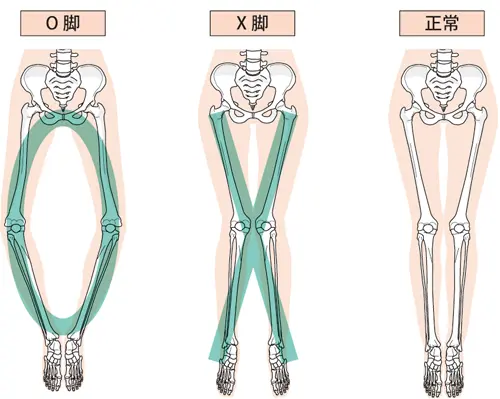 O脚・X脚・正常な足のイラスト