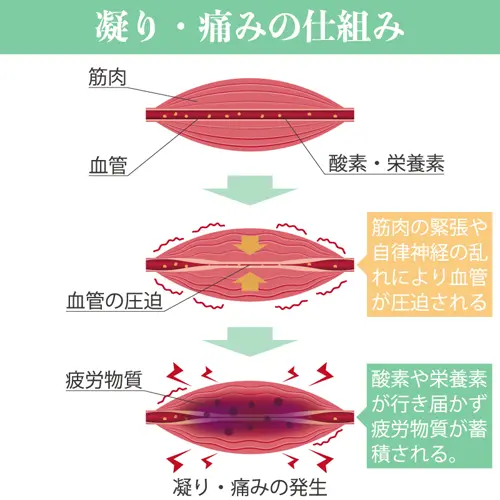 凝り・痛みの仕組み図解イラスト